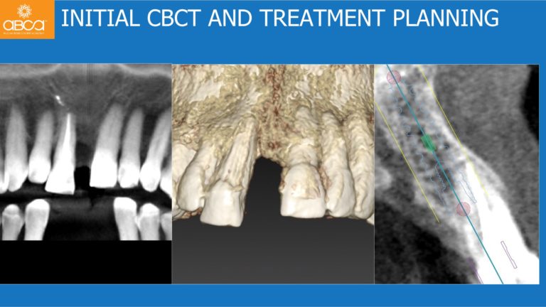 Immediate Loading in the Aesthetic Zone of Tooth 